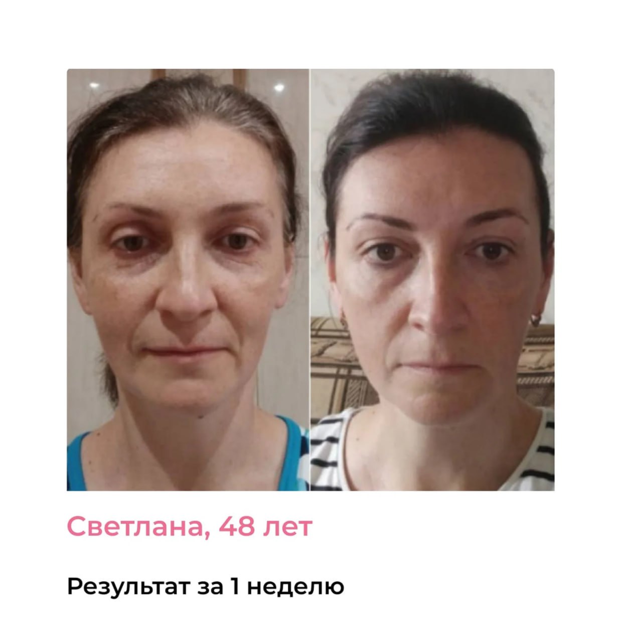 Результат: носогубные складки