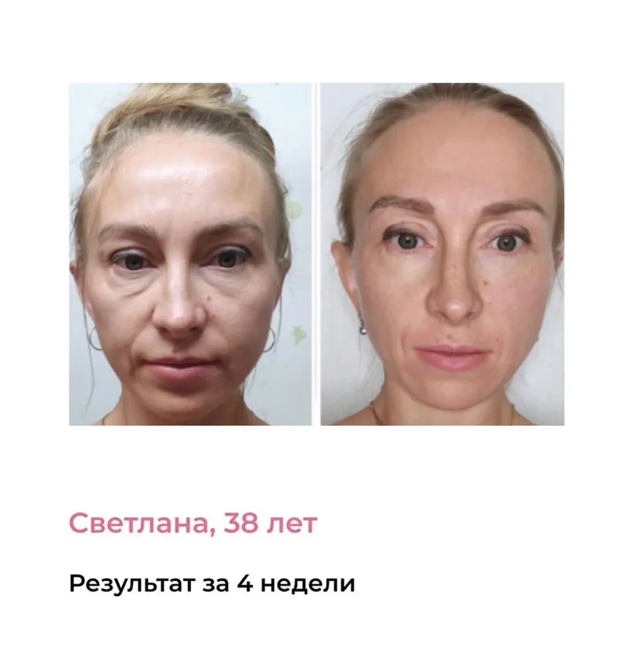 Результат: отёки и круги под глазами